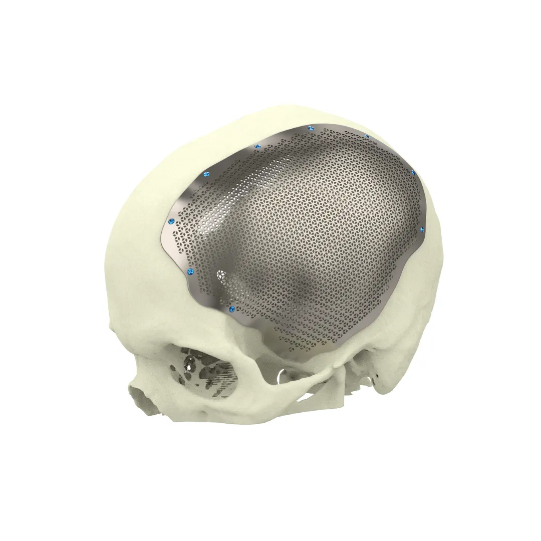 Skull Implant