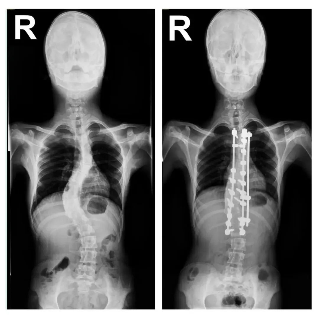 Scoliosis